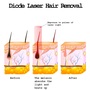 755nm+808nm+940nm+1064nm Diode Laser Hair Removal Machine
